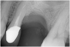 篠崎３ GBR　抜歯後4ヶ月・GBR前